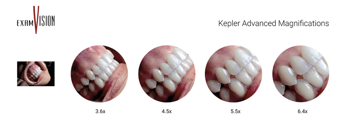 Powiekszenia lupy stomatologiczne Kepler Advanced